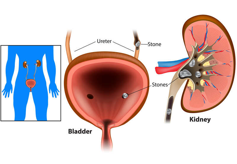Digital-illustration-of-kidney-stones Digital-illustration-of-kidney-stones