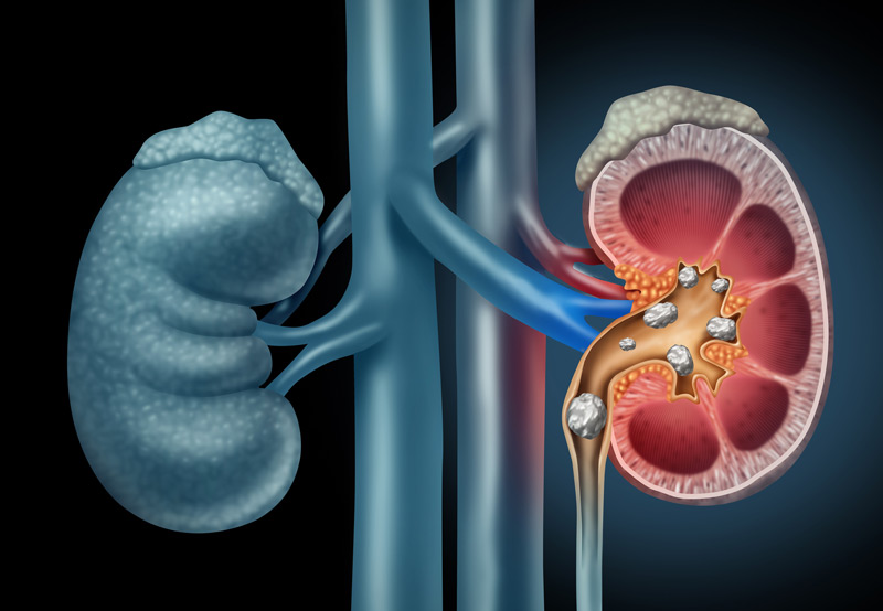 Kidney Stones